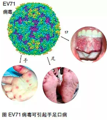 什么是手足口病?图片